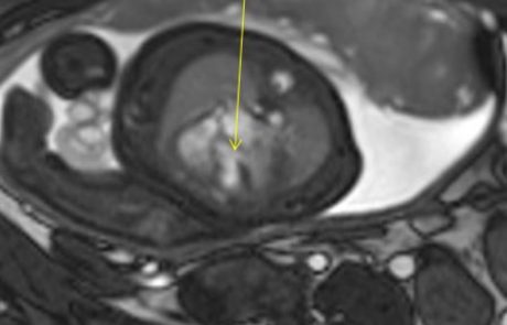 לראשונה בישראל: בדיקת MRI לאבחון מום לב בעובר