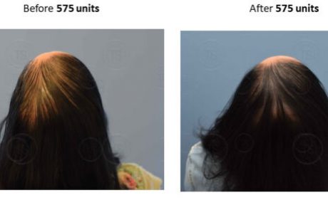 היירסטטיקס – השתלה של שיער סינתטי לנשים
